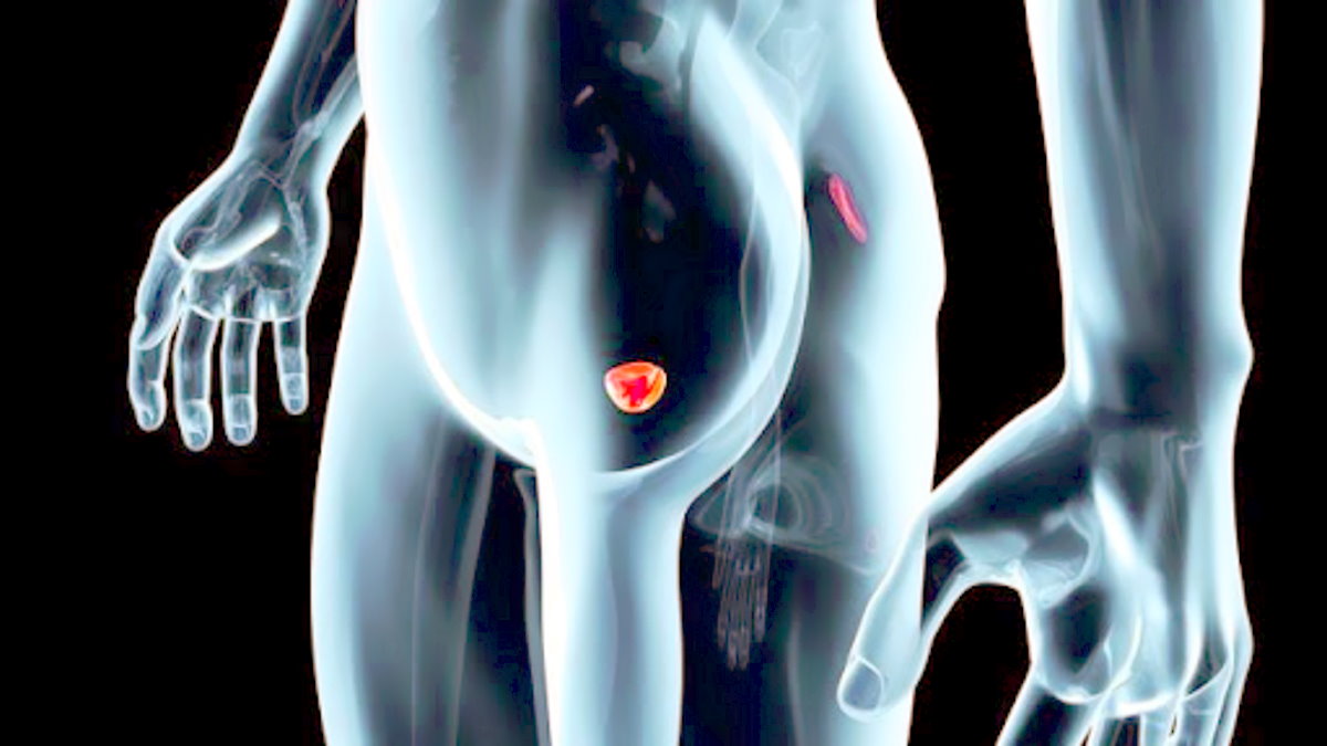 In Europa circa 450.000 nuovi casi di tumore alla prostata ogni anno: un dato allarmante dell'associazione urologi europei