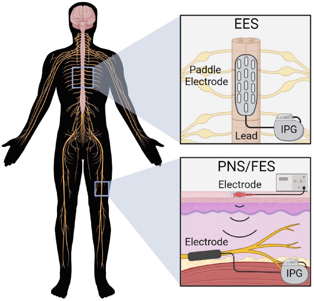 Stimolazione elettrica del midollo spinale: una nuova frontiera per il trattamento della spasticità muscolare